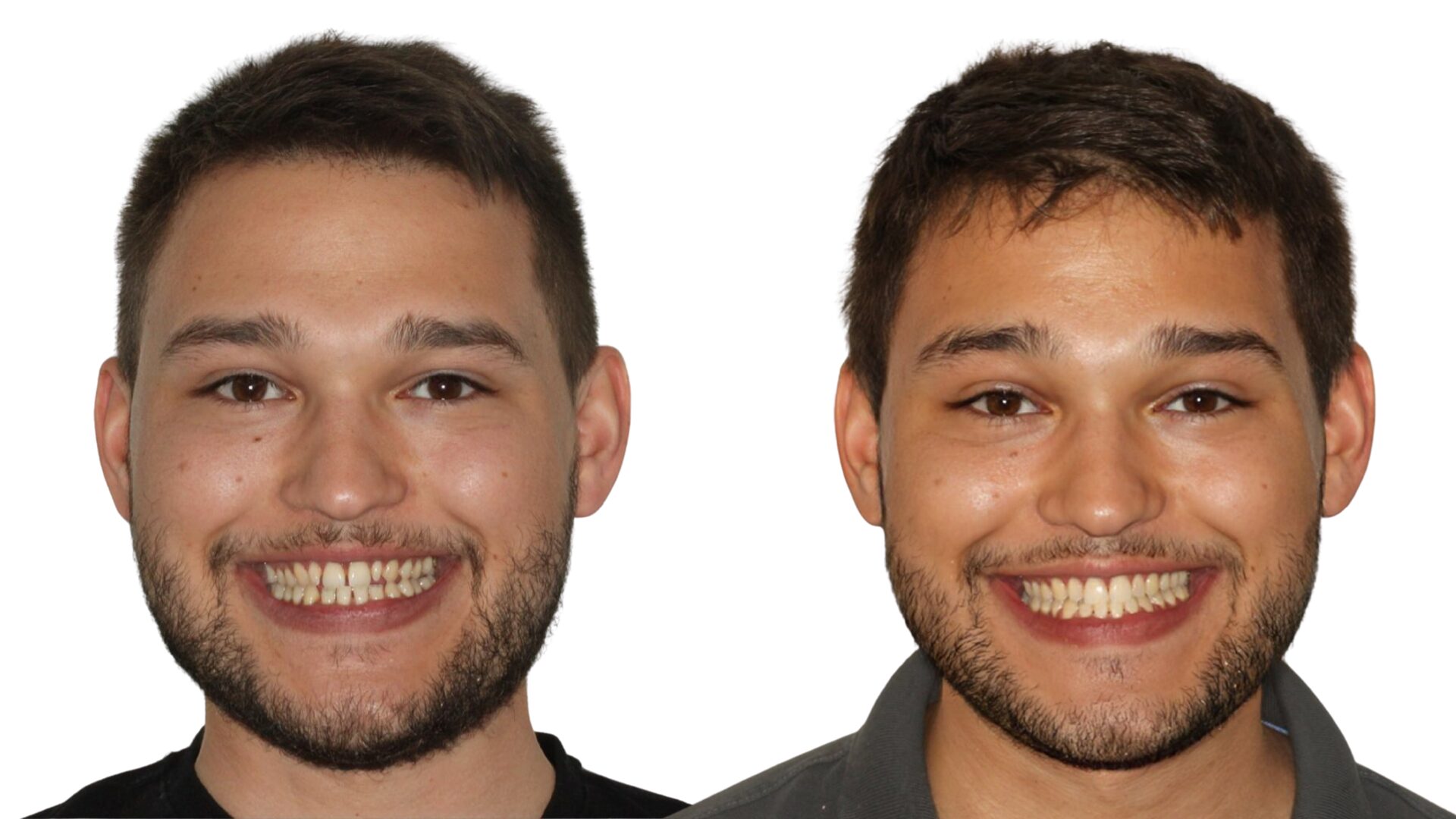 Razmaci između više zubi kod pacijenta u dvadesetim godinama