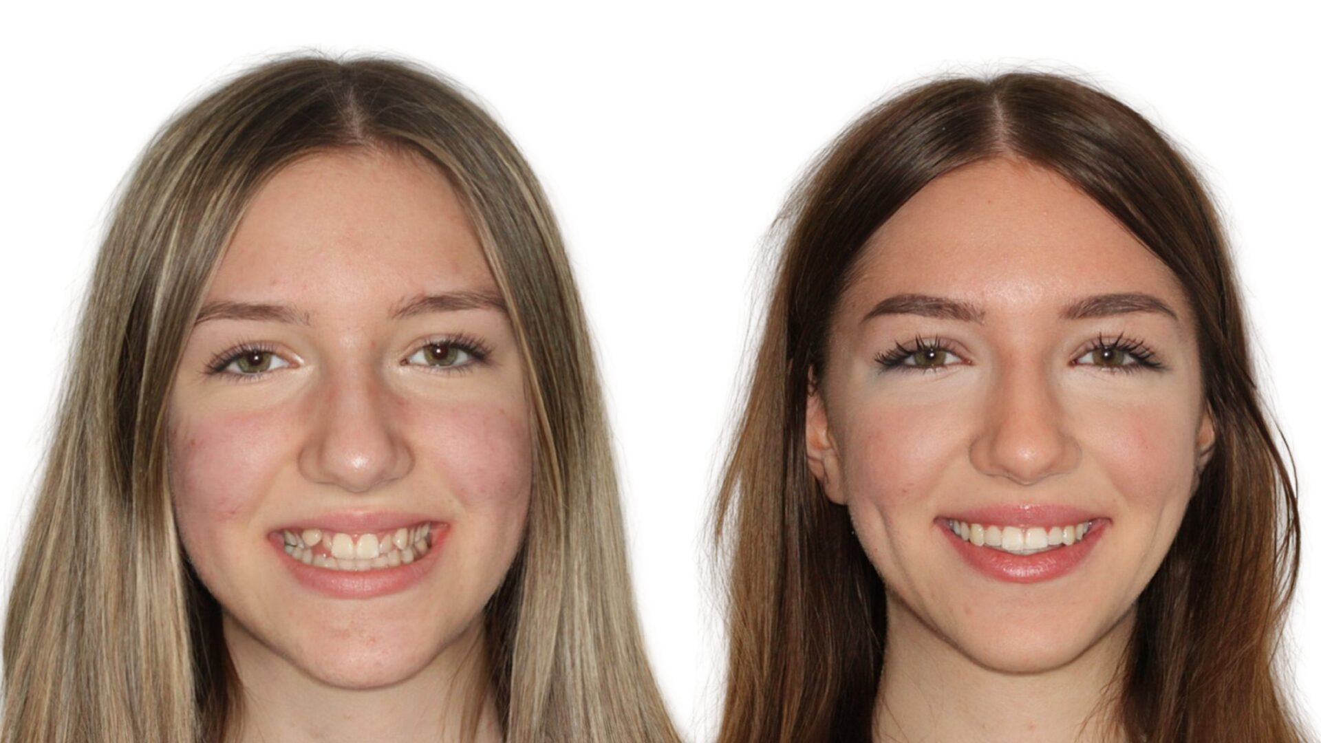 Slika prije i poslije terapije kod dr. Leile iz Ortolook-a