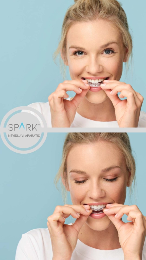 Spark-nevidljivi-aparatic-Ortolook-Zagreb-iskustvo