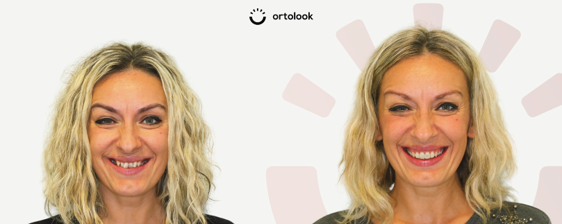 Pacijent-dr-Leila-prije-i-poslije-ortodont-Ortolook-zagreb