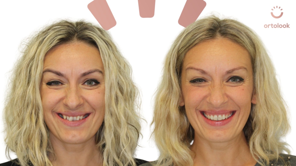 Smile-Longevity-velika-promjena-Ortolook-Zagreb-ortodoncija